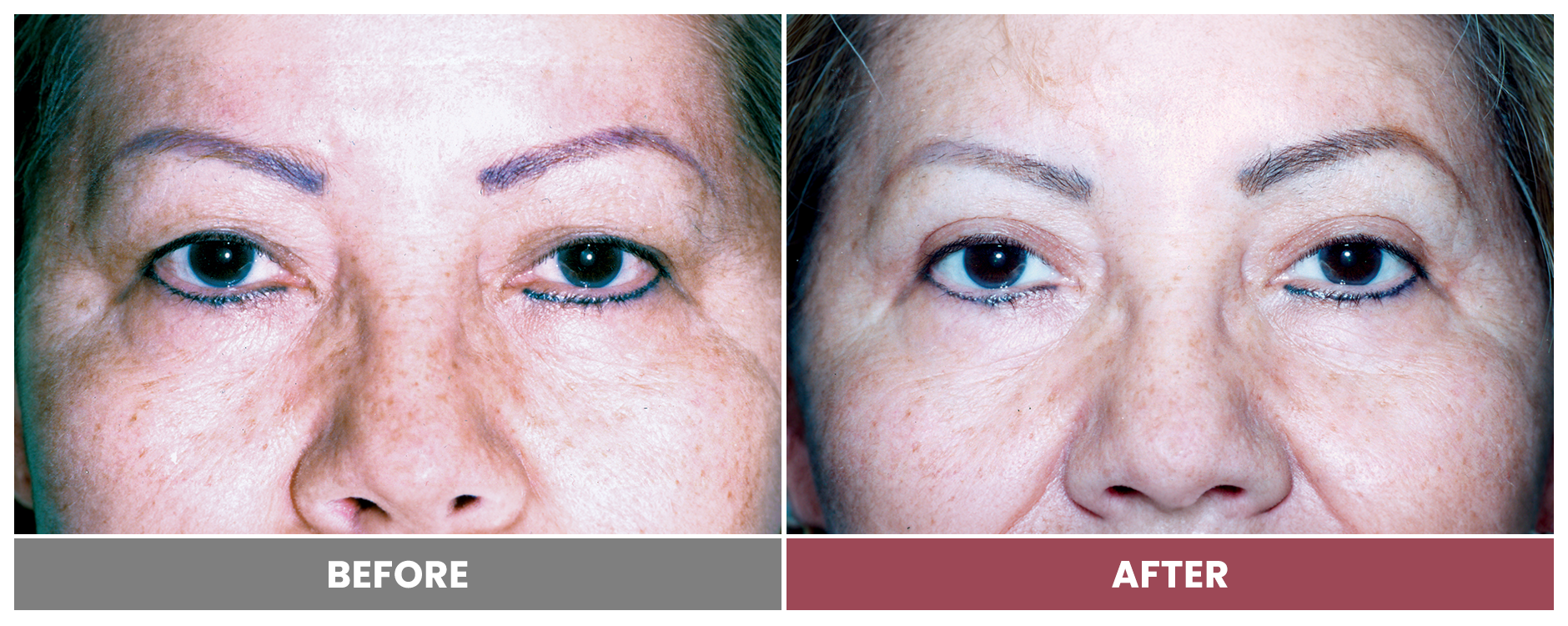BLEPHAROPLASTY & PTOSIS REPAIR - Case 8
